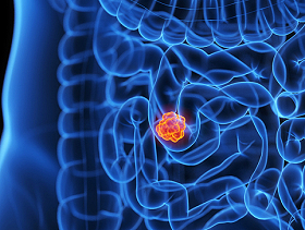 بدقة تفوق 95%: الذكاء الاصطناعيّ يضاهي الأطباء في تشخيص الداء البطني